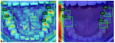 Нейросеть против кариеса: новая разработка ЮФУ